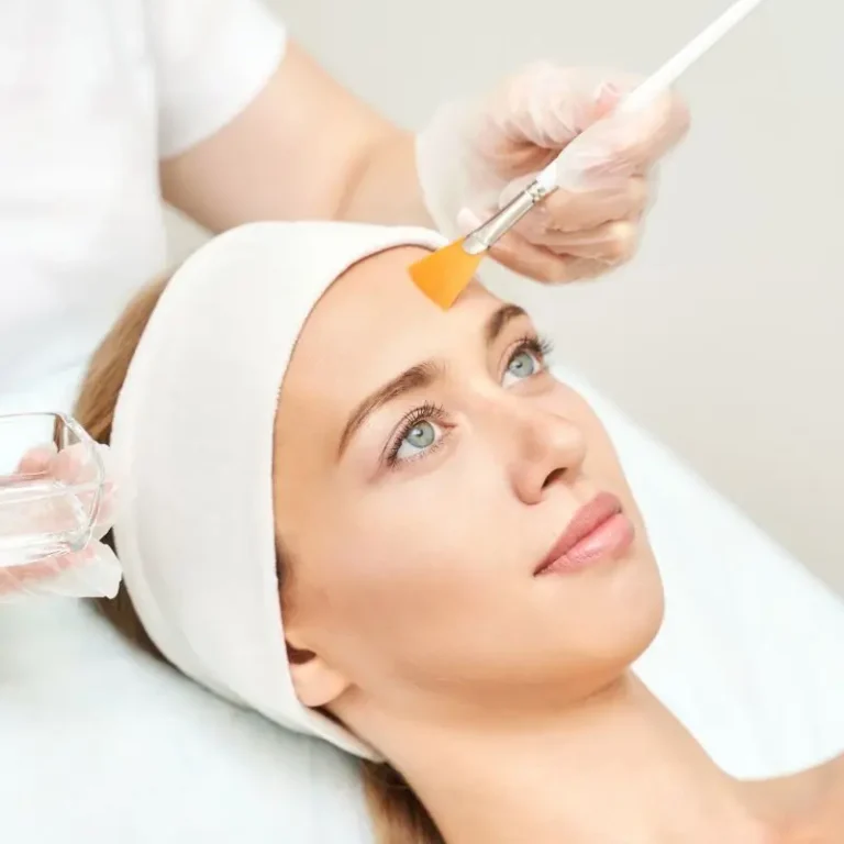 chemical peel