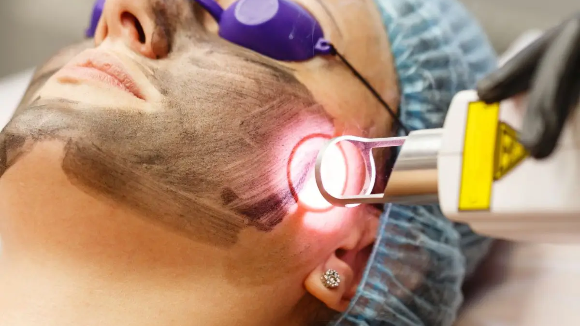 laser dark spot removal