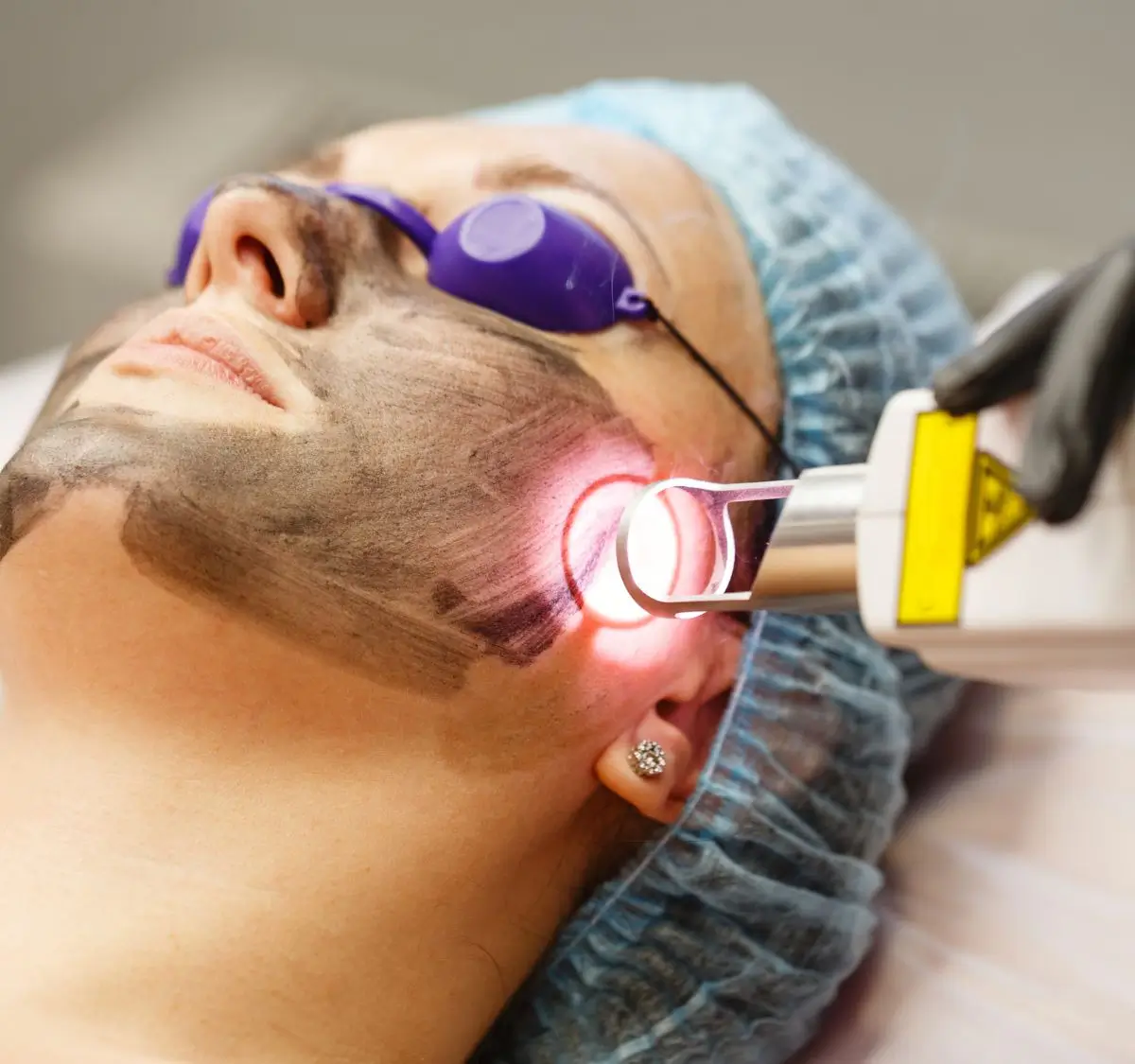 Laser Dark Spot Removal Clear Advanced Technology