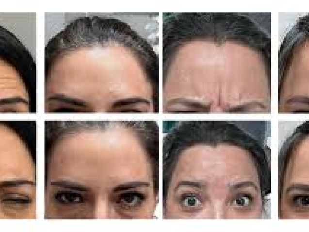 Home 10 Botox vs Dysport