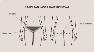 Brazilian laser hair removal