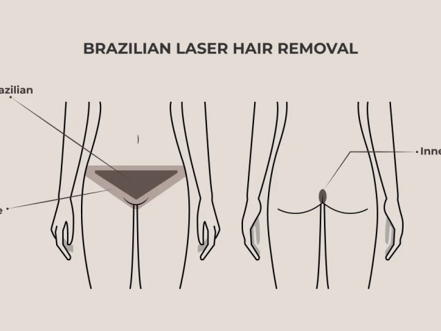 Brazilian laser hair removal