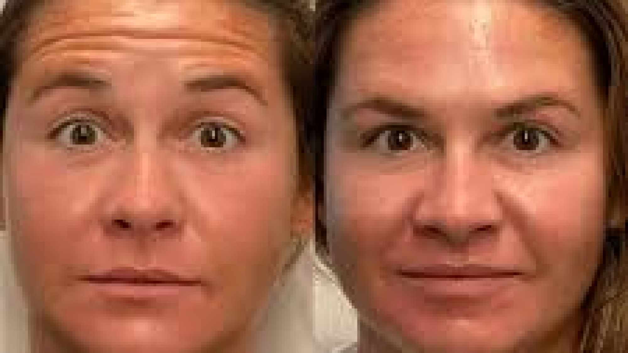 How Long Does Botox Take to Work? A Complete Guide