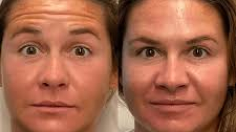 How Long Does Botox Take to Work? A Complete Guide