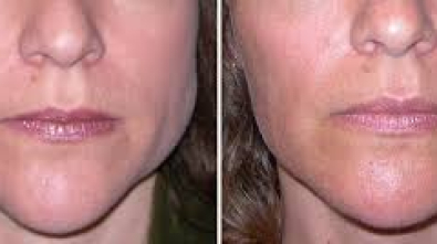 What Is Masseter Muscle Botox and How Can It Help?