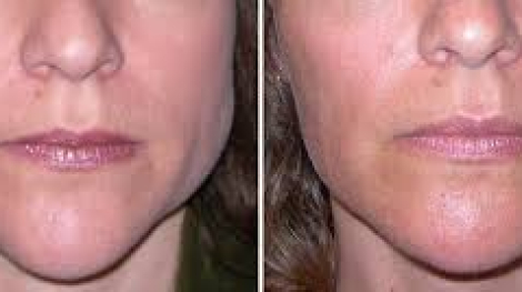 What Is Masseter Muscle Botox and How Can It Help?