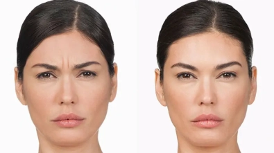 What Is a Botox Brow Lift and Is It Right for You