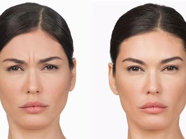 What Is a Botox Brow Lift and Is It Right for You