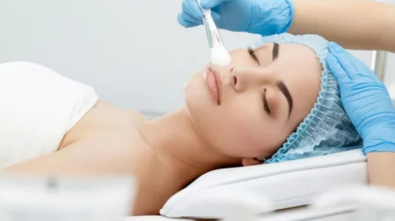 Chemical Peels