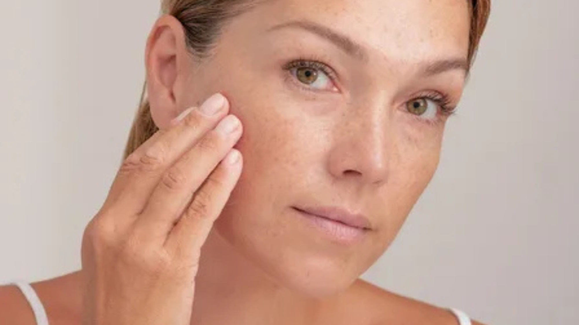 Melasma 101