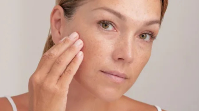 Melasma 101
