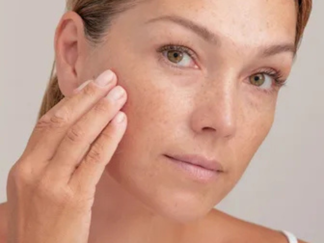 Melasma 101