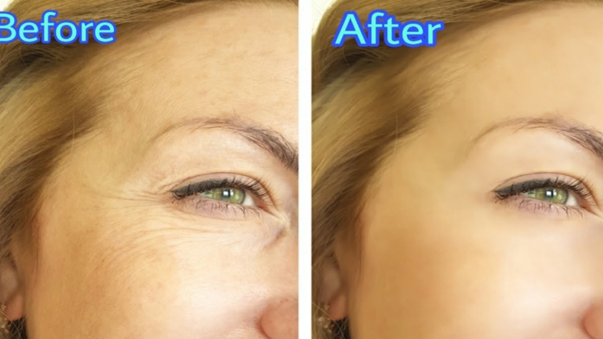 After a Botox