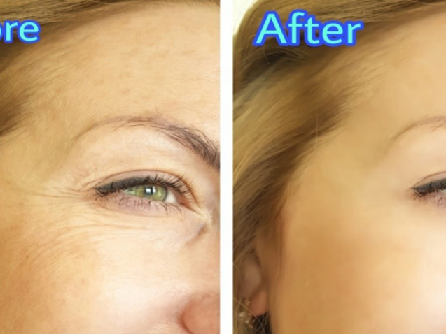 Home 12 After a Botox