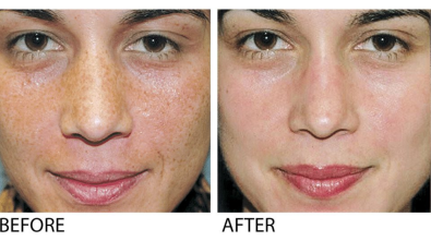 Before & After a VI Peel