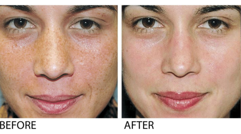 Before & After a VI Peel