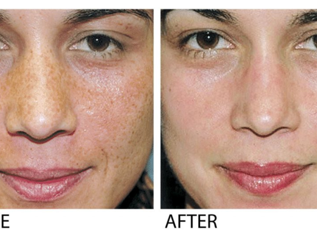 Before & After a VI Peel