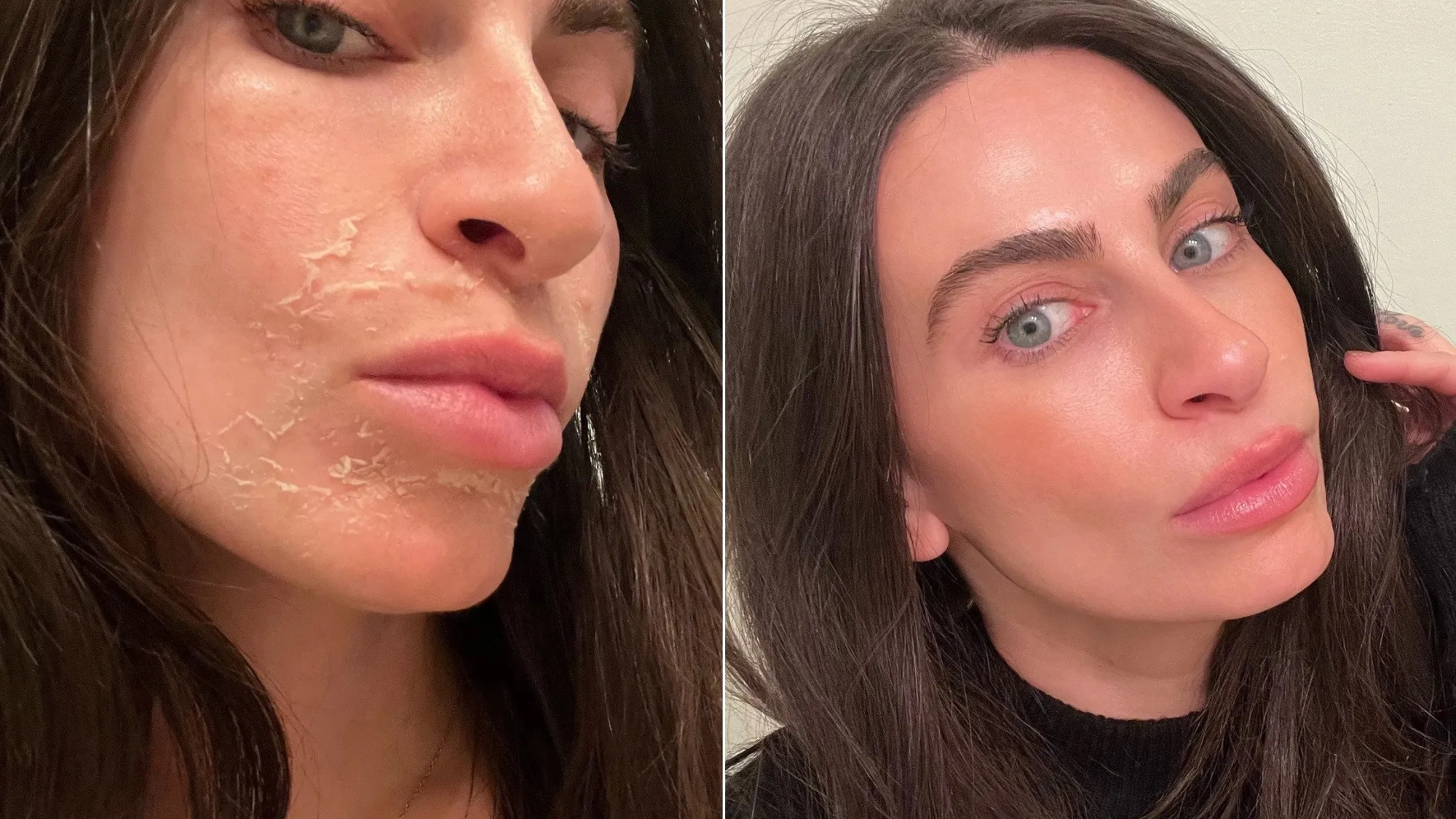 VI Peel Before and After