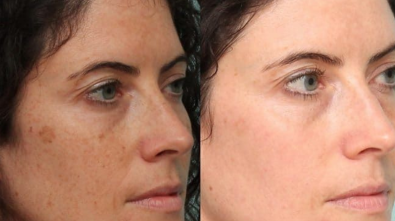 Laser Dark Spot Removal