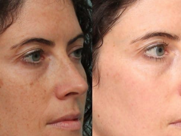 Laser Dark Spot Removal